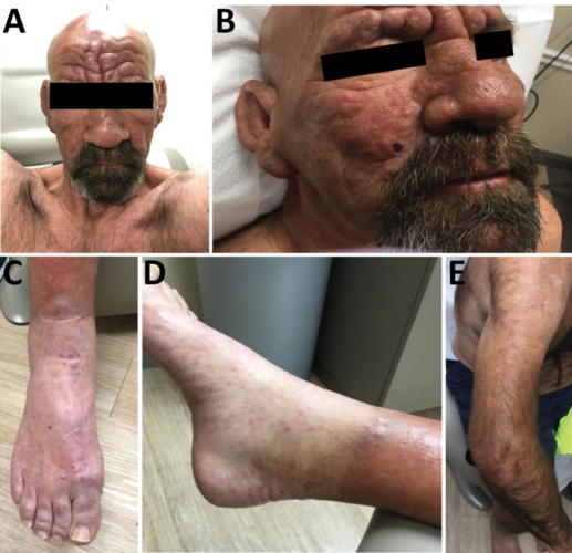 Leprosy is making a comeback as uncommon cases in Central Florida cause the CDC to issue a warning advisory for all travelers heading to the Sunshine State.  